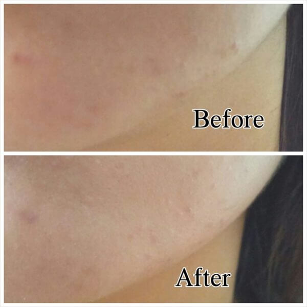 Hiruscar post acne scar gel sebelum selepas